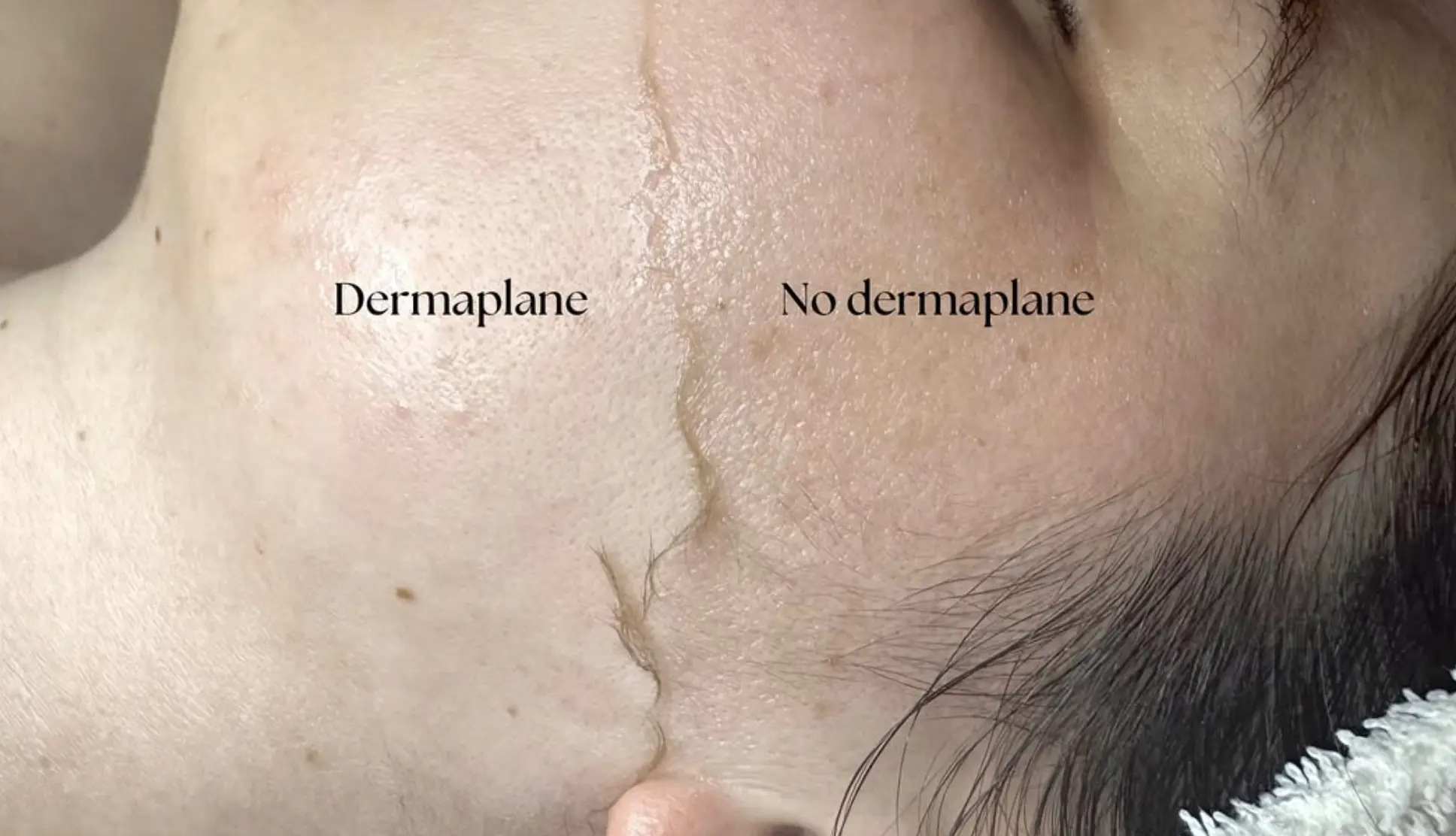 dermaplaning Brisbane