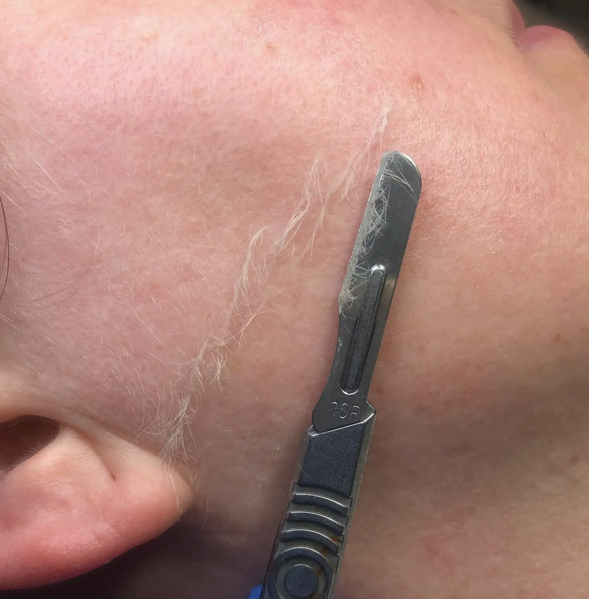 dermaplaning vs shaving