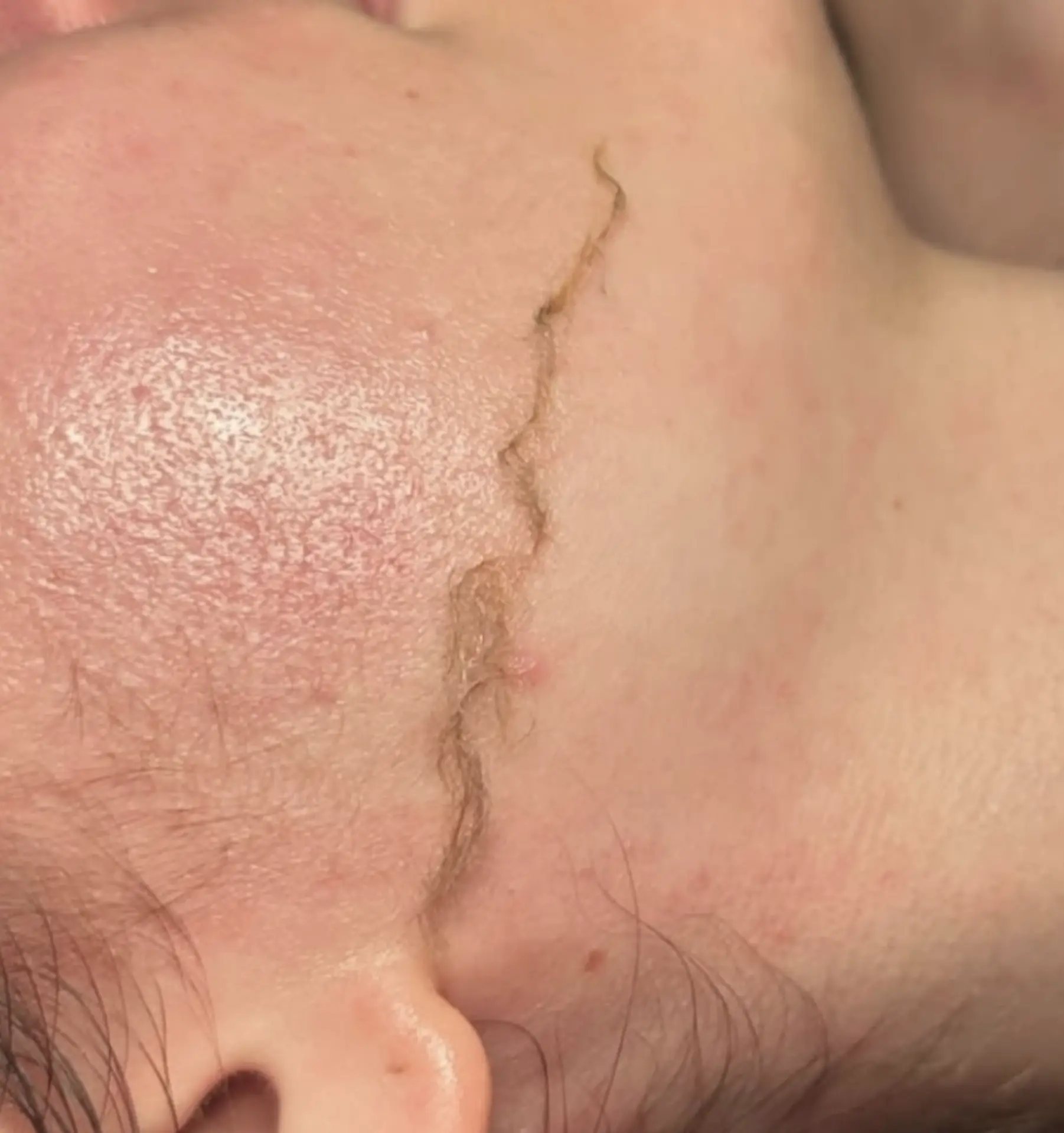 professional dermaplaning benefits