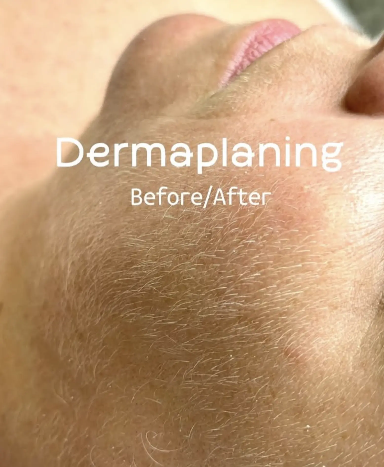 surgical scalpel dermaplaning