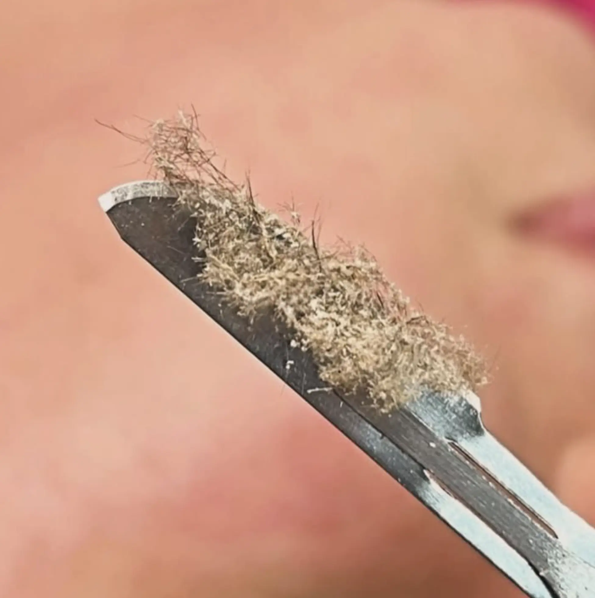 what is dermaplaning